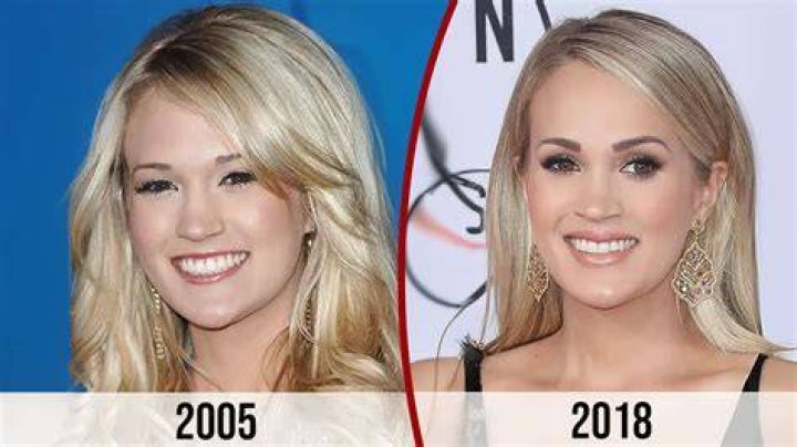 Carrie Underwood before and after plastic surgery Celebrity plastic