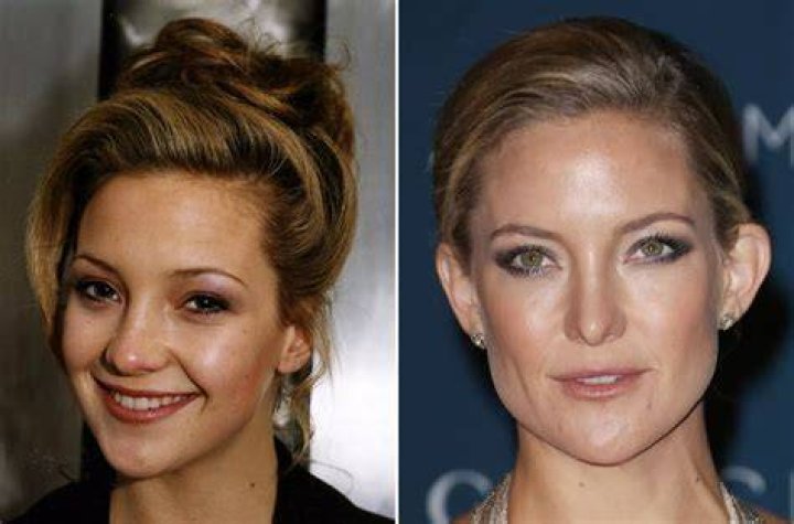 Celebrity Nose Jobs Before & After Mirror Online
