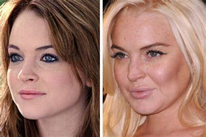 Chatter Busy Lindsay Lohan Nose Job