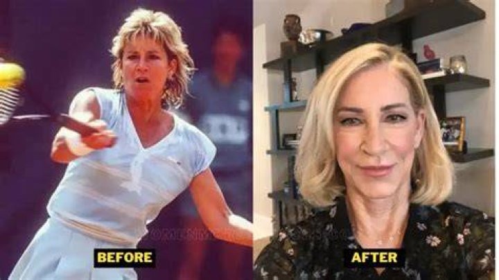 Chris Evert Before and After, Has Chris Evert Had Plastic Surgery? ·
