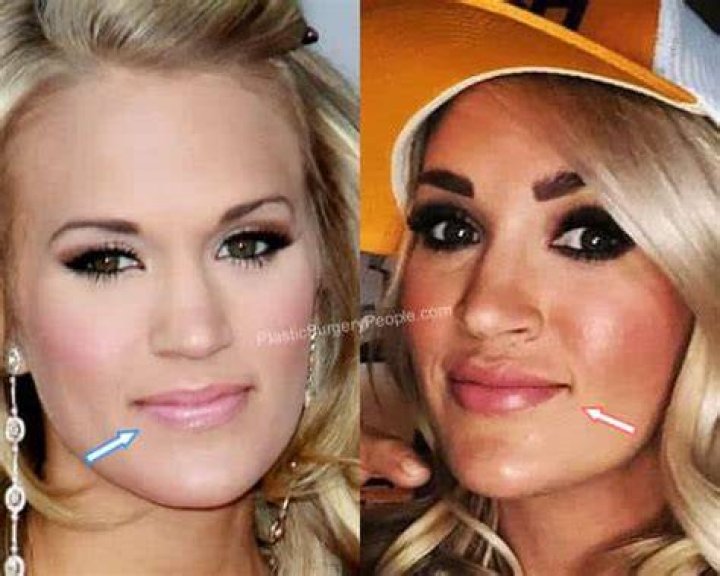 Did Carrie Underwood Get Her Lips Done? Plastic Surgery |