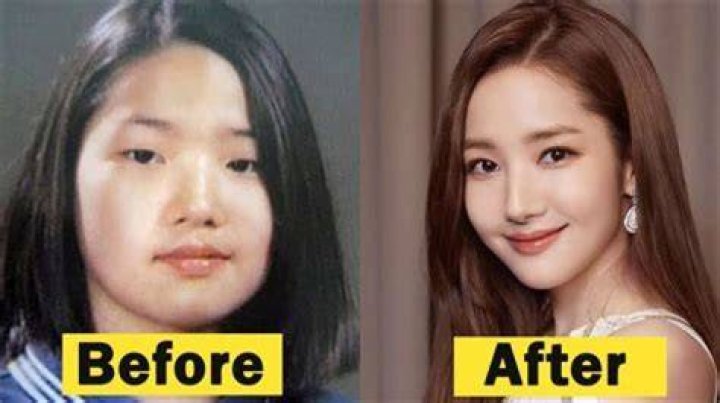 Did Yeonmi Park Undergo Plastic Surgery in Real?