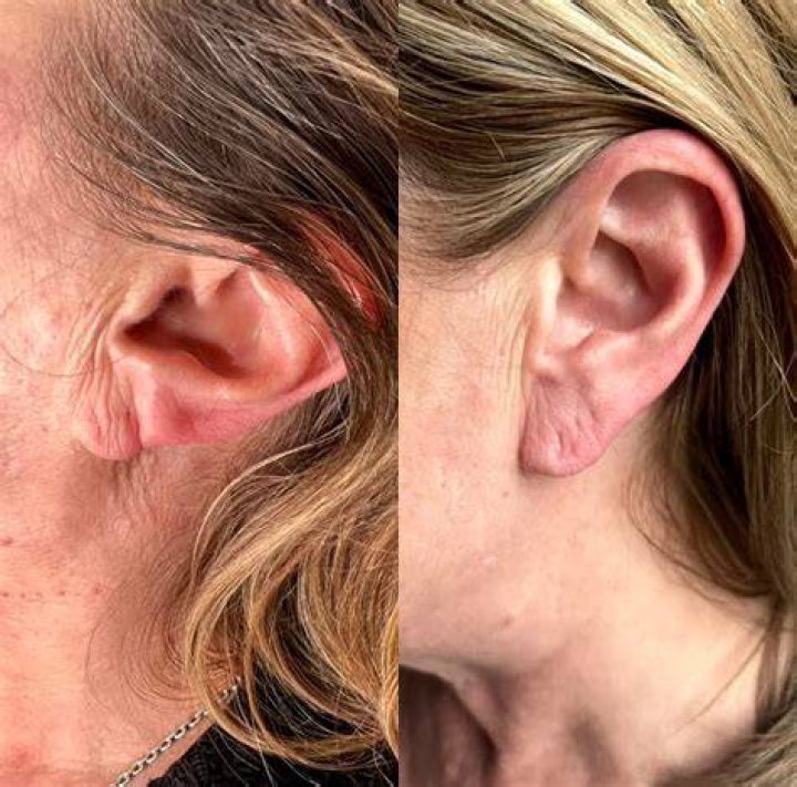 Earlobe fillers yes, it's a... Novice Group Dermatology Facebook