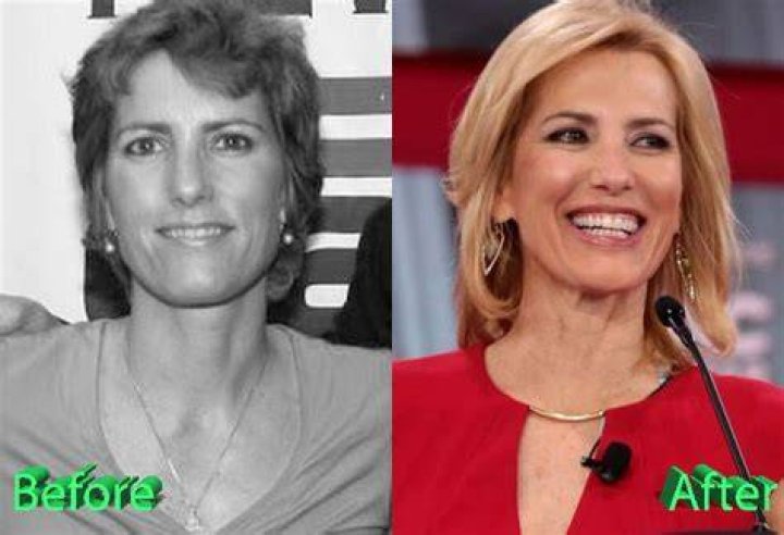 Exploring Laura Ingraham's Plastic Surgery Journey
