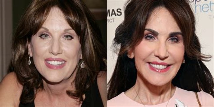 Has Robin McGraw Gotten Plastic Surgery?