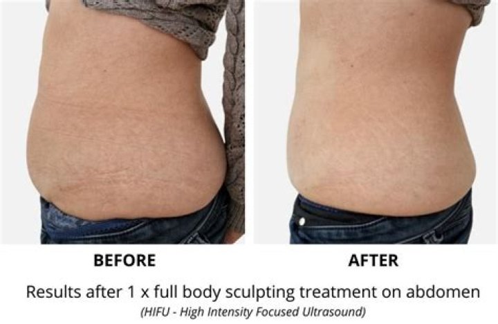 How Does Body Sculpting Actually Work?