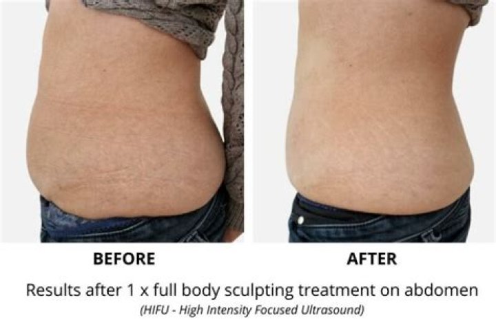 How Does Body Sculpting Work? REPC