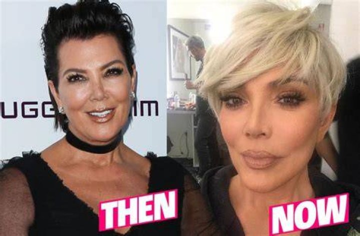 Kris Jenner Plastic Surgery