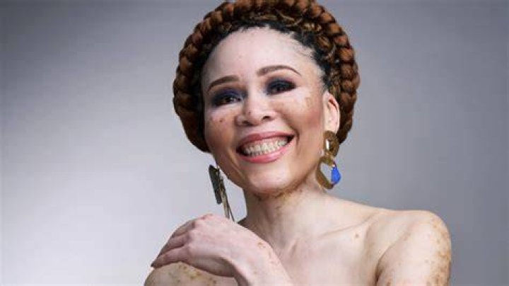 Leleti Khumalo's Vitiligo: Unraveling The Mystery