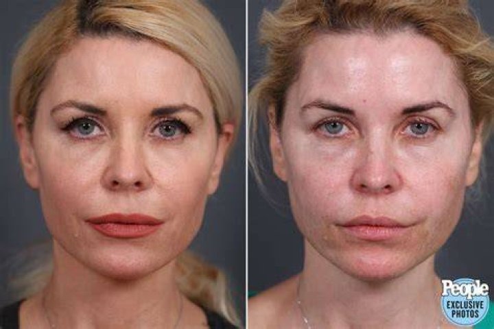 McKenzie Westmore Talks Undergoing Reconstructive Surgery After Bad Filler