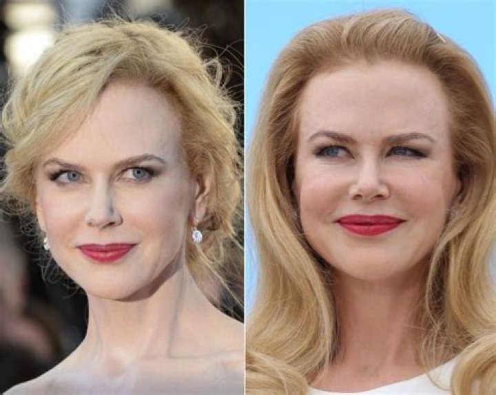 Nicole Kidman before and after plastic surgery (21) Celebrity plastic
