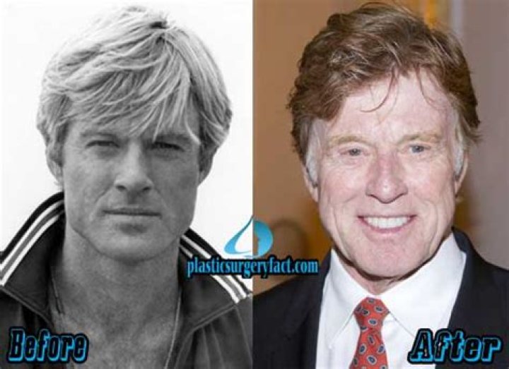 Robert Redford Plastic Surgery Before and After Photo,Facelift, Filler