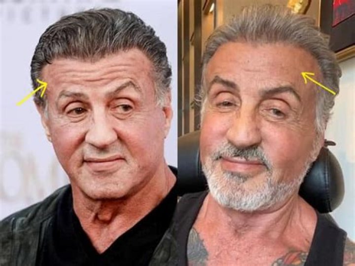Sylvester Stallone Plastic Surgery Has Definitely Gone Wrong