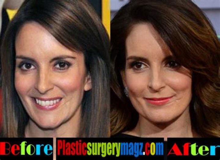 Tina Fey Plastic Surgery Before and After Tina Fey Face Scar