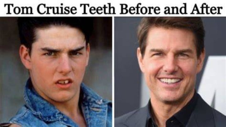 Tom Cruise Teeth Before And After Braces Celebrity Teeth Before And