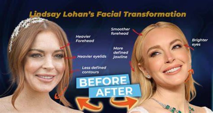 Unveiling Lindsay Lohan's Nose Job: Secrets And Revelations